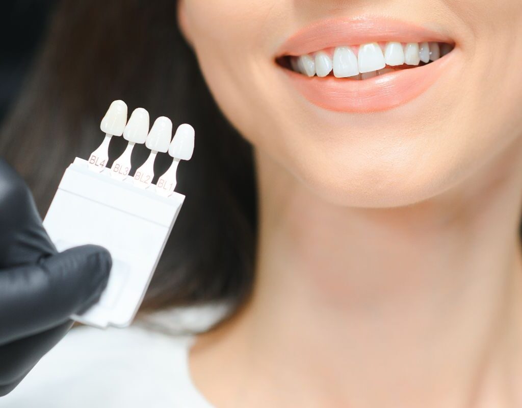 Blanqueamiento dental: mitos y verdades que necesitas saber 1 blanqueamiento dental